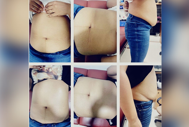 Diastasis Recti physical therapy exercises