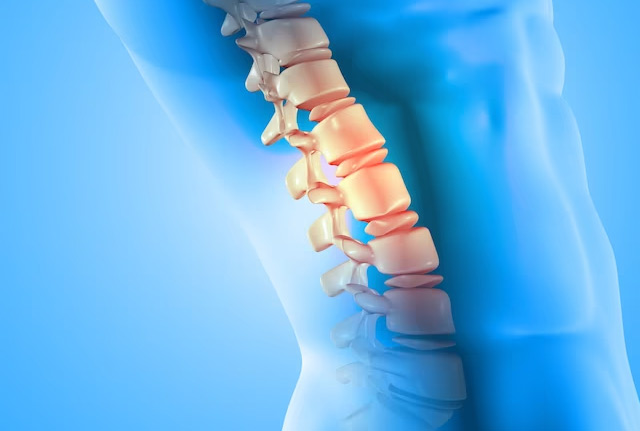 Prolapsed Intervertebral Disc spine diagram